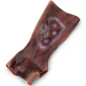 Simulaids Forearm with Simulated 2nd & 3rd Degree Burns
